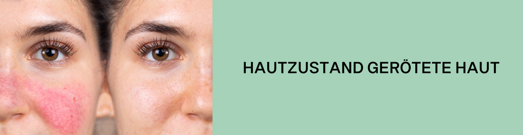 GERÖTETE HAUT
